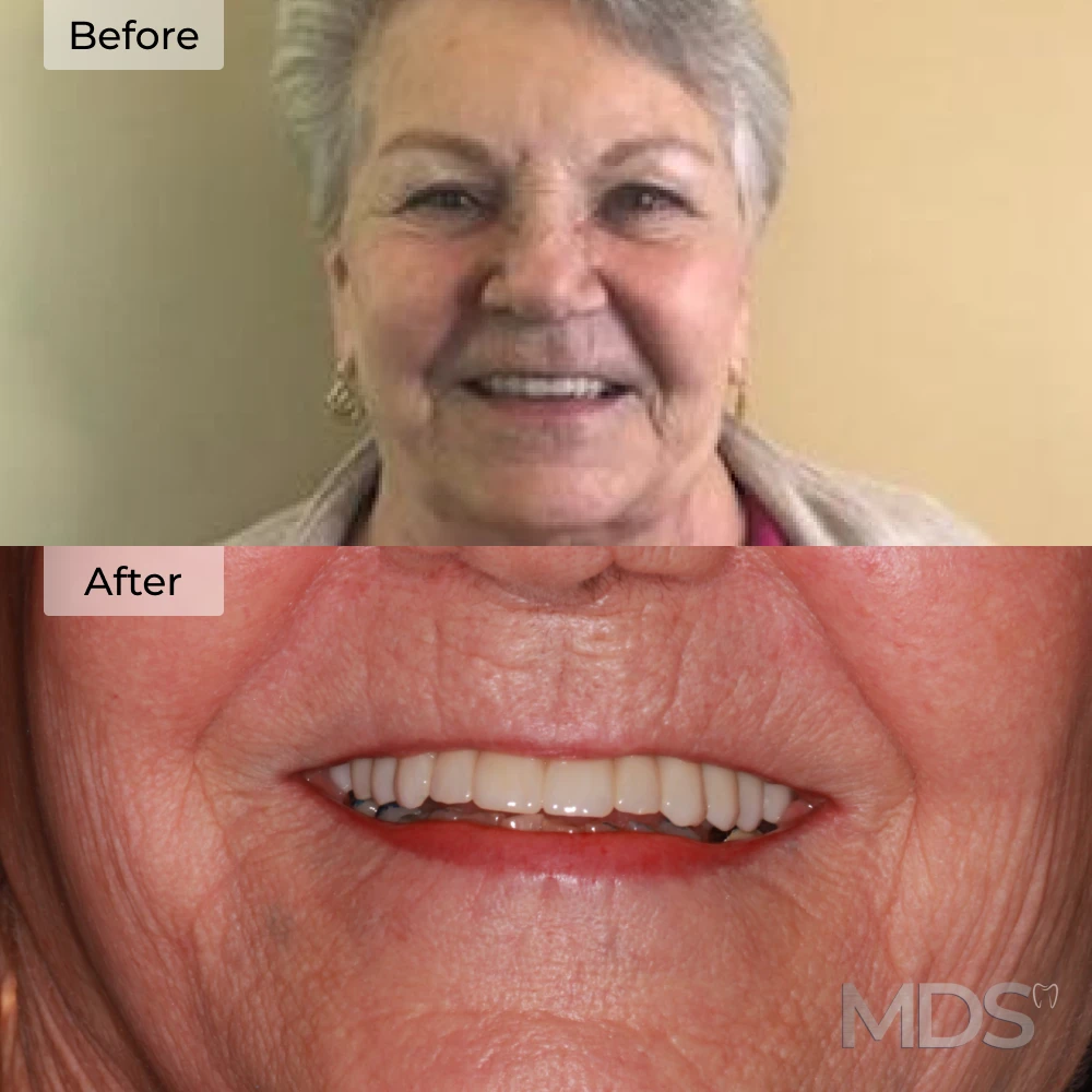 Before and after dental implants in Howell, MI at Michigan Dental Studio