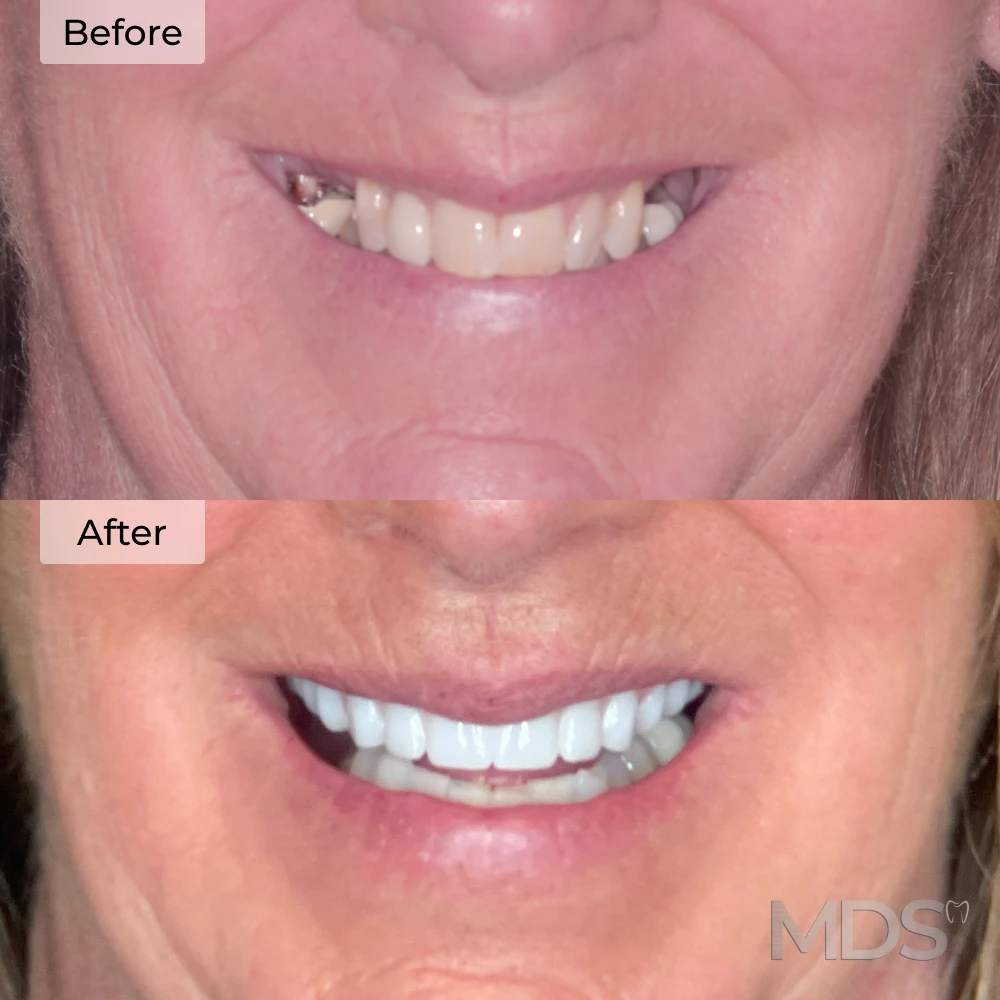 Before and after dental implants in Howell, MI at Michigan Dental Studio