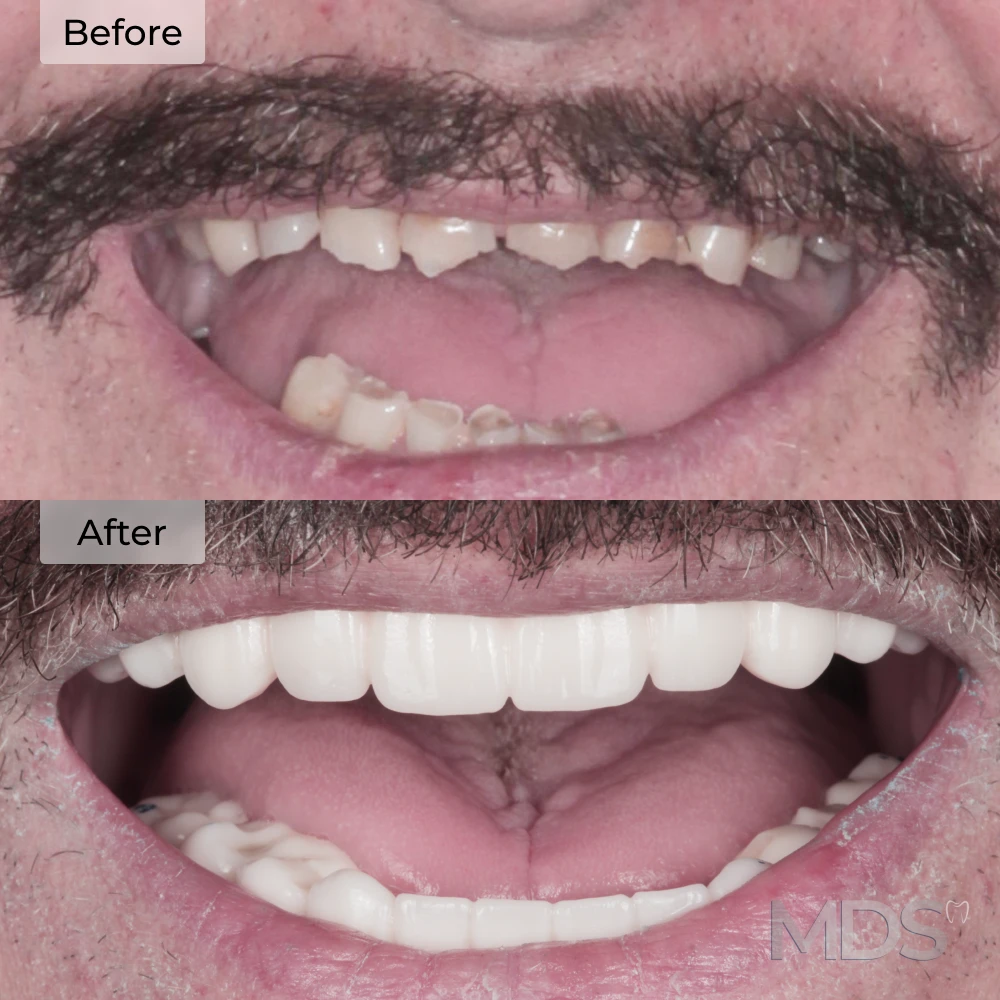 Before and after dental implants in Howell, MI at Michigan Dental Studio