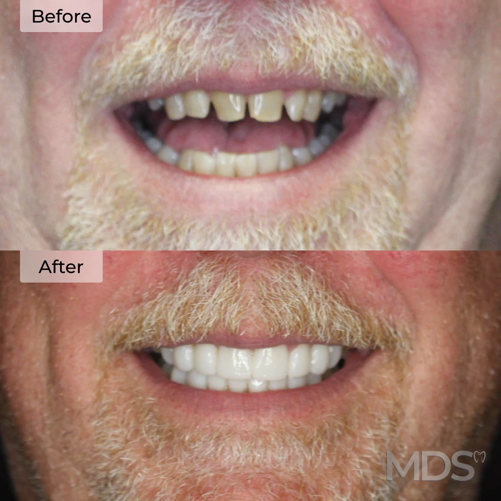 Before and after dental implants in Howell, MI at Michigan Dental Studio