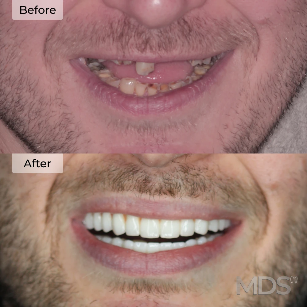 Before and after dental implants in Howell, MI at Michigan Dental Studio