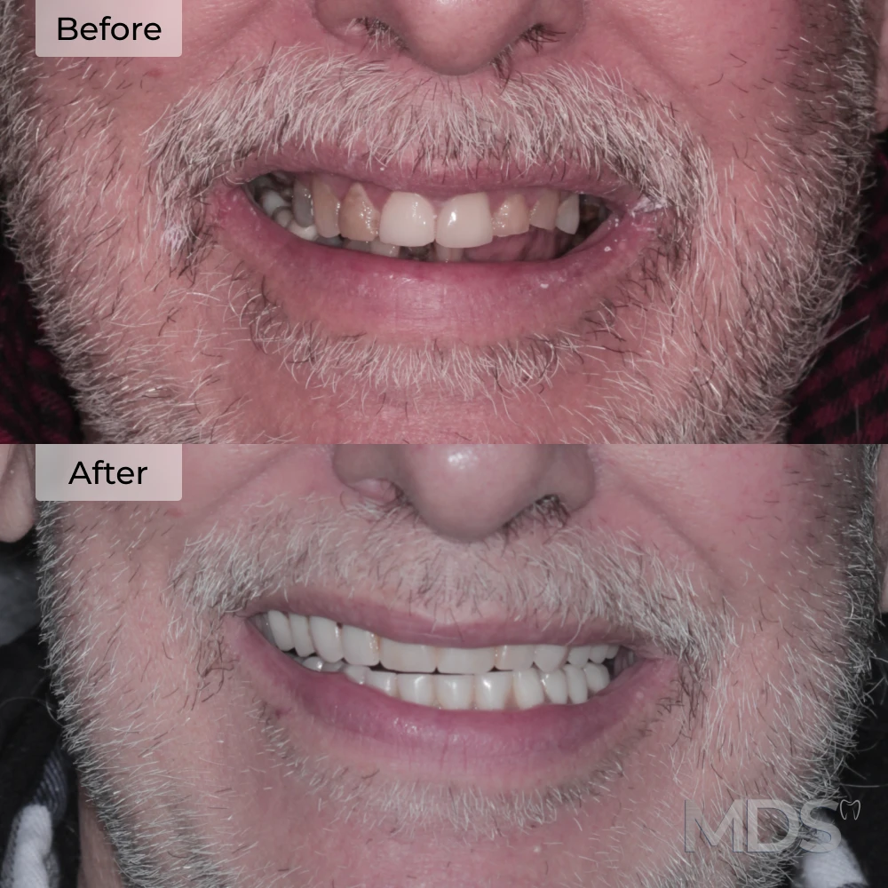 Before and after dental implants in Howell, MI at Michigan Dental Studio