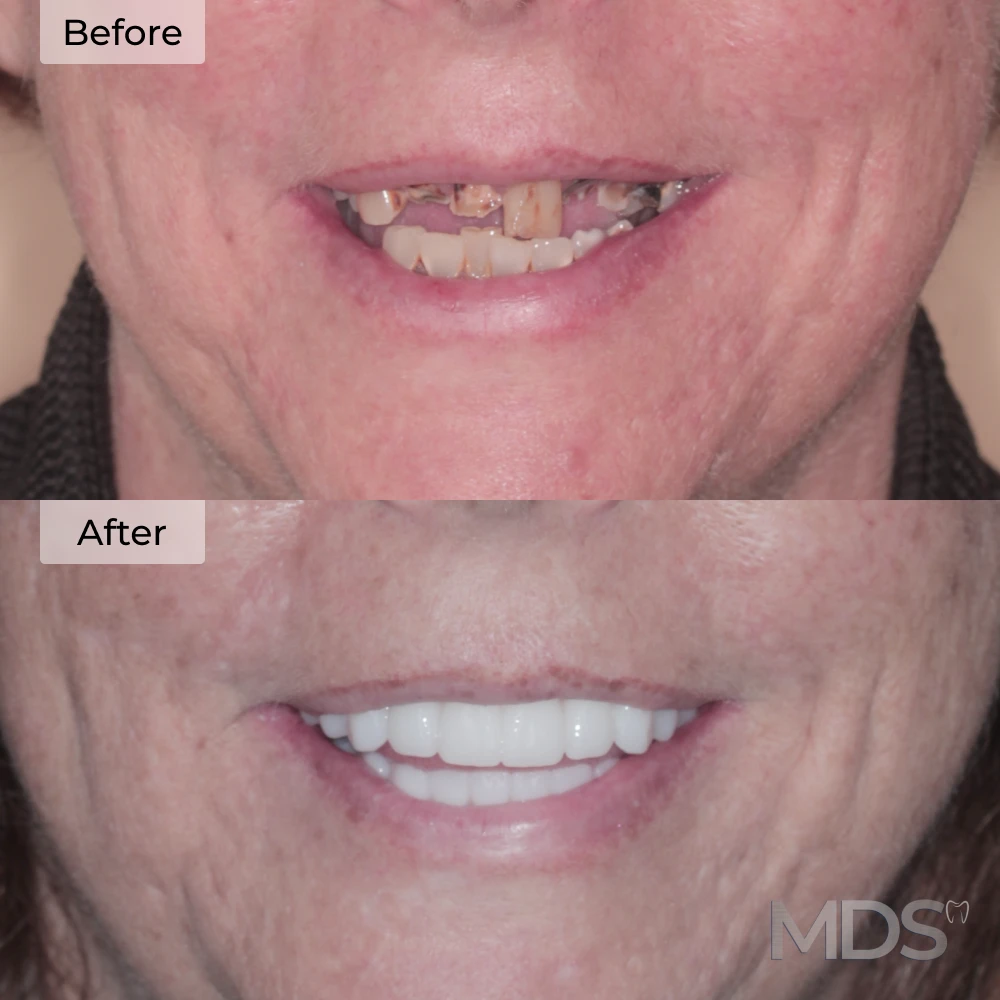 Before and after dental implants in Howell, MI at Michigan Dental Studio