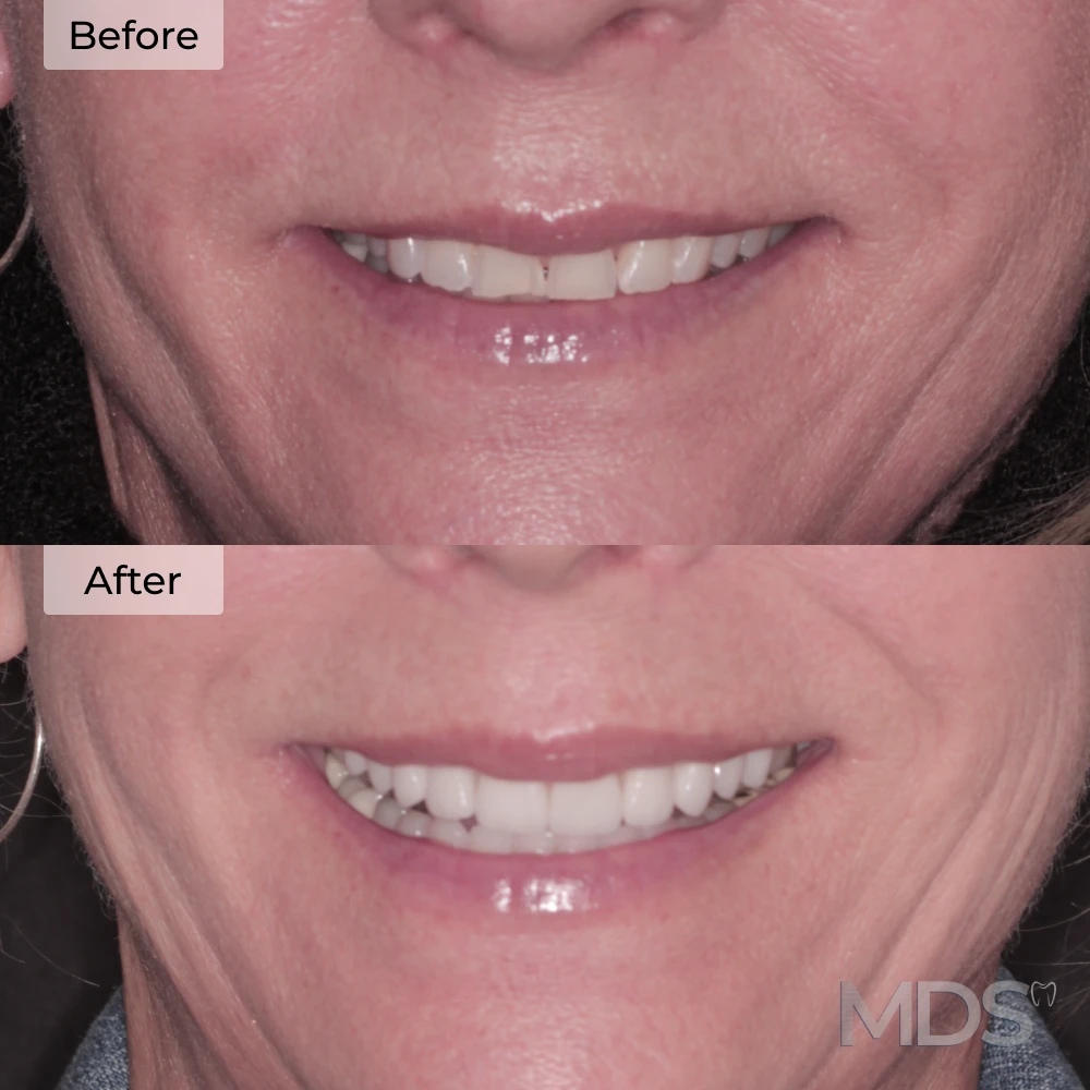 Veneers before and after at Michigan Dental Studio in Howell, MI