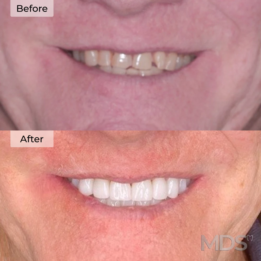 Veneers before and after at Michigan Dental Studio in Howell, MI