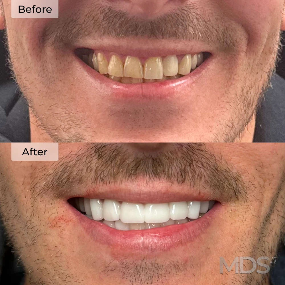 Veneers before and after at Michigan Dental Studio in Howell, MI